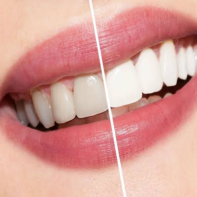 Hismile Instant Teeth Whitening